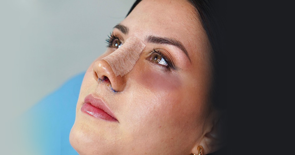 درمان کبودی بعد از عمل بینی 